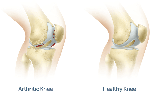 knee-arthritis-rosa