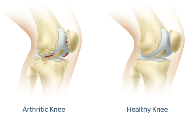 https://www.michiganadvancedsurgery.com/wp-content/uploads/knee-compressor.png